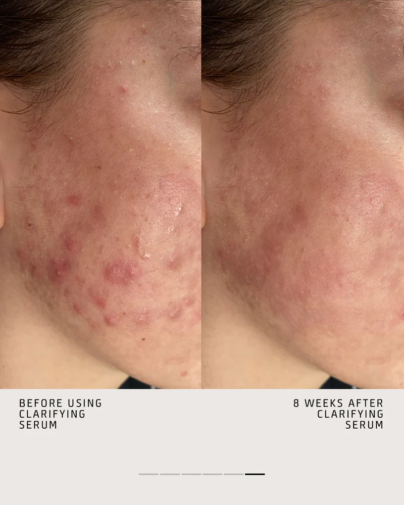 before-n-after-claryfing-serum